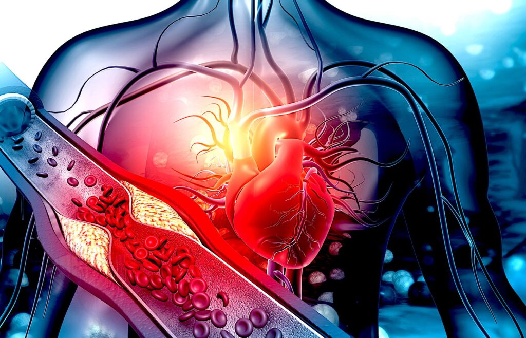 Preventie hipercolesterolemie ateroscleroza